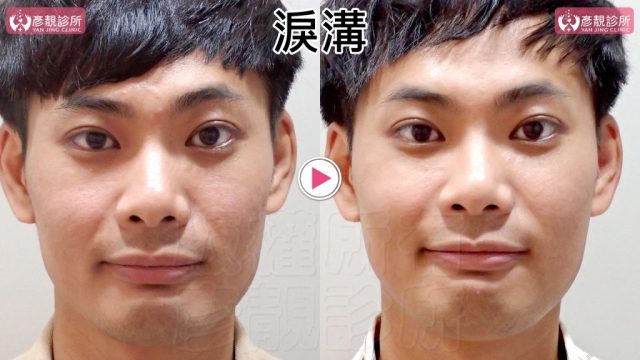 Marionette Lines Nasolabial Folds Hyaluronic Acid 09302 1024x576