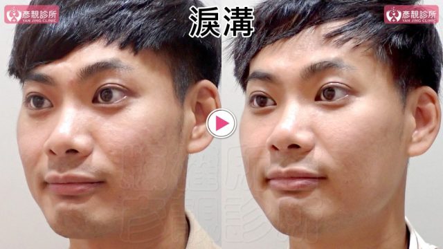 Marionette Lines Nasolabial Folds Hyaluronic Acid 09303 1024x576