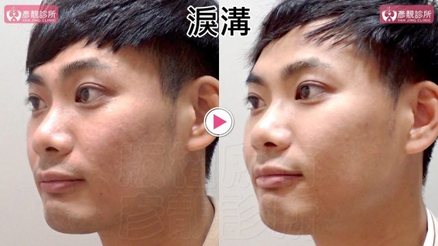 Marionette Lines Nasolabial Folds Hyaluronic Acid 09304 1024x576