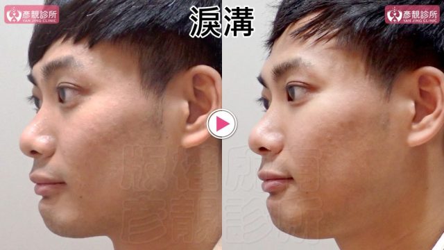 Marionette Lines Nasolabial Folds Hyaluronic Acid 09305 1024x576