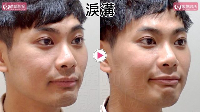 Marionette Lines Nasolabial Folds Hyaluronic Acid 09306 1024x576