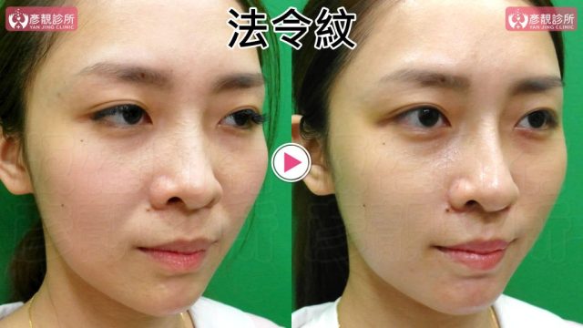 Marionette Lines Nasolabial Folds Hyaluronic Acid10021 1024x576