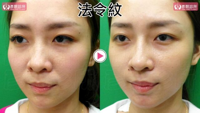 Marionette Lines Nasolabial Folds Hyaluronic Acid10022 1024x576