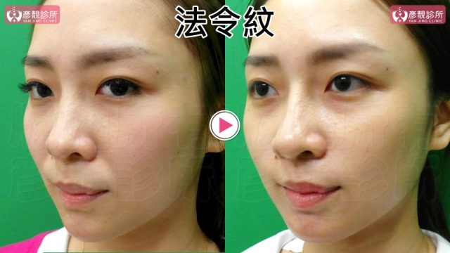 Marionette Lines Nasolabial Folds Hyaluronic Acid10023 1024x576