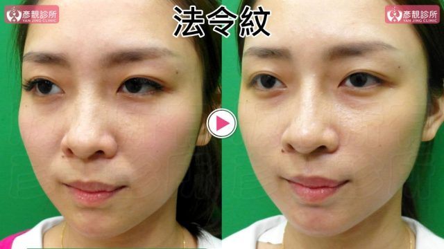 Marionette Lines Nasolabial Folds Hyaluronic Acid10024 1024x576