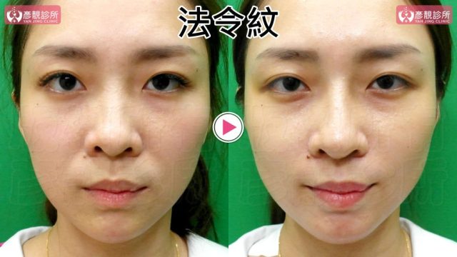 Marionette Lines Nasolabial Folds Hyaluronic Acid10025 1024x576