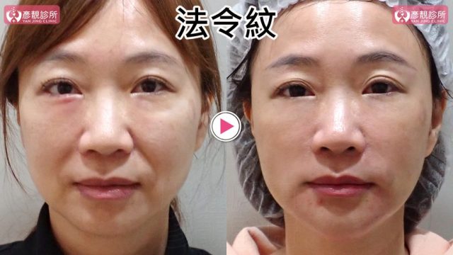 女性法令紋術前術後正面近照，右圖雙側鼻翼旁凹折與口角上方陰影較淡，中臉前側接向嘴角更平順；大分子玻尿酸依血管與組織層次安全支撐，不以單一紋路的過量填充改變臉型