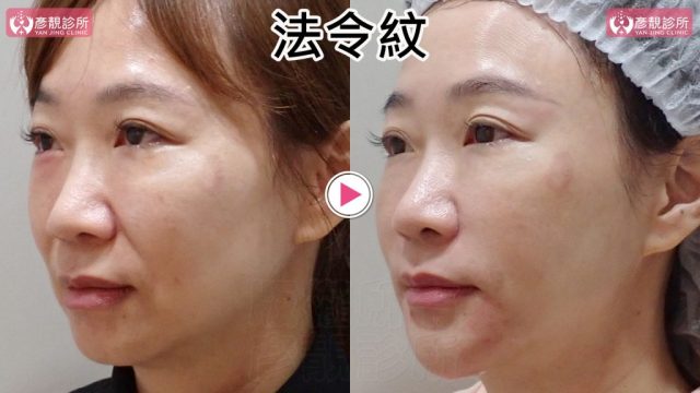 女性法令紋術前術後斜側近照，右圖鼻翼旁凹折與口角上方暗線較淡，臉頰前側輪廓更連續；大分子玻尿酸依血管與組織區間安全配置，不把材料集中在法令紋表面造成厚重外觀