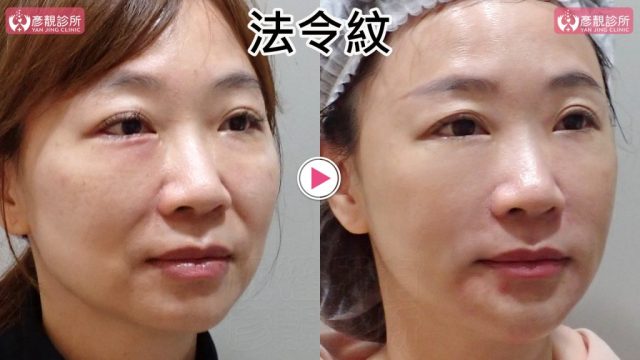 女性法令紋術前術後正面稍轉近照，右圖鼻翼旁凹線與嘴角周圍陰影較淡，中臉接向口周的弧度更連續；大分子玻尿酸配合4D無痕筋膜提升，依相鄰組織支撐而非沿紋路堆疊