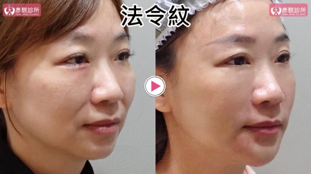 女性法令紋術前術後斜側近照，右圖鼻翼旁上段凹折與口角上方暗帶較淡，臉頰前側接向嘴角更平順；4D無痕筋膜提升依中臉向量建立支撐，讓材料留在預定組織區間以降低位移