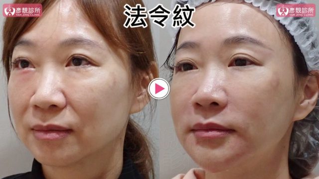 女性法令紋術前術後斜側近照，右圖鼻翼旁凹折、臉頰下緣及嘴角上方陰影較淡，中臉外觀更自然；4D無痕筋膜提升依體積與位置安排支點，不把所有材料集中在法令紋低點