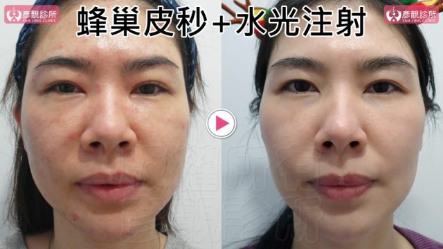 Under Eye Bags-Tear Trough-Dark Circle Injection-Dark Circles10101 Under Eye Bags Tear Trough Dark Circle Injection Dark Circles10101 1024x576