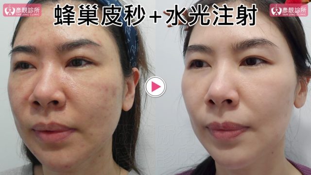Under Eye Bags-Tear Trough-Dark Circle Injection-Dark Circles10102 Under Eye Bags Tear Trough Dark Circle Injection Dark Circles10102 1024x576