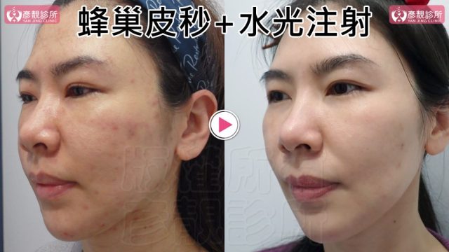 Under Eye Bags-Tear Trough-Dark Circle Injection-Dark Circles10103 Under Eye Bags Tear Trough Dark Circle Injection Dark Circles10103 1024x576