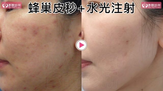 Under Eye Bags-Tear Trough-Dark Circle Injection-Dark Circles10104 Under Eye Bags Tear Trough Dark Circle Injection Dark Circles10104 1024x576