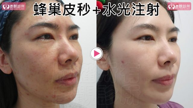 Under Eye Bags-Tear Trough-Dark Circle Injection-Dark Circles10105 Under Eye Bags Tear Trough Dark Circle Injection Dark Circles10105 1024x576