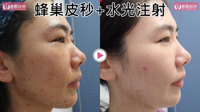 Under Eye Bags-Tear Trough-Dark Circle Injection-Dark Circles10106 Under Eye Bags Tear Trough Dark Circle Injection Dark Circles10106 1024x576