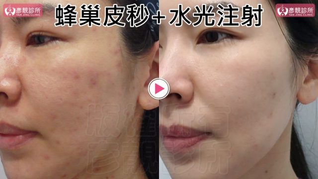 Under Eye Bags-Tear Trough-Dark Circle Injection-Dark Circles10107 Under Eye Bags Tear Trough Dark Circle Injection Dark Circles10107 1024x576