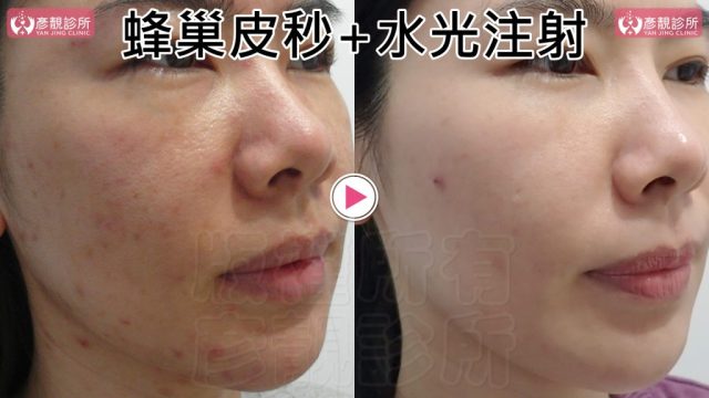Under Eye Bags-Tear Trough-Dark Circle Injection-Dark Circles10108 Under Eye Bags Tear Trough Dark Circle Injection Dark Circles10108 1024x576