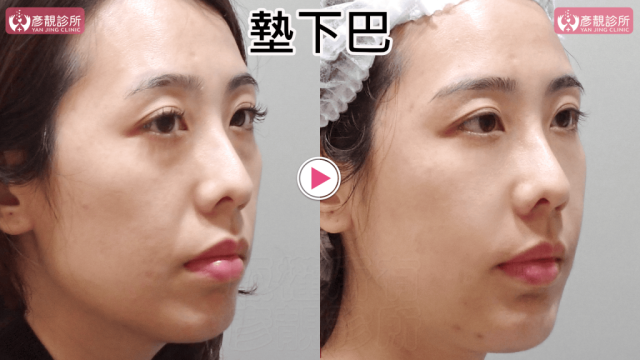 墊下巴65