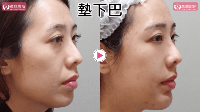 墊下巴66