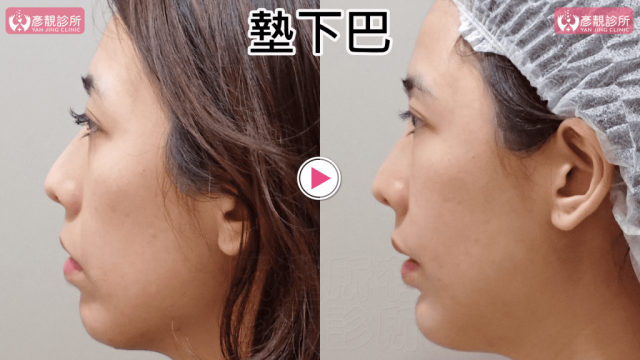 墊下巴69