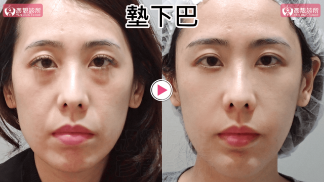 墊下巴64