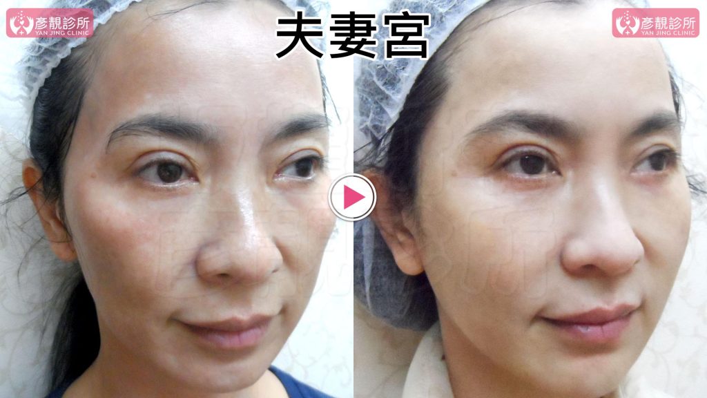 筆者的案例透過大分子玻尿酸填補夫妻宮後改善夫妻宮凹陷太陽穴凹陷的問題