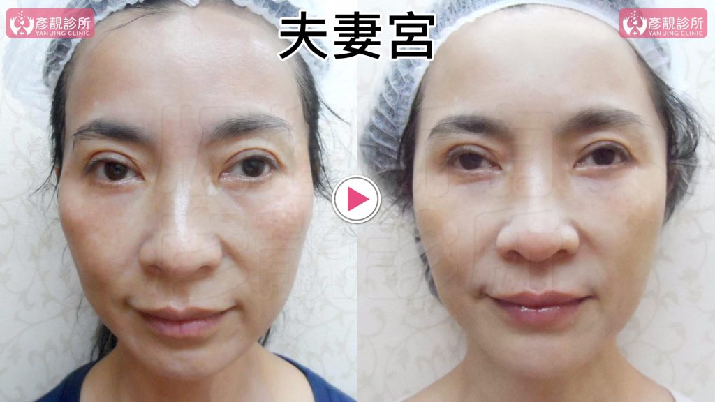 黃政達醫師透過大分子玻尿酸填補後改善個案夫妻宮凹陷太陽穴凹陷