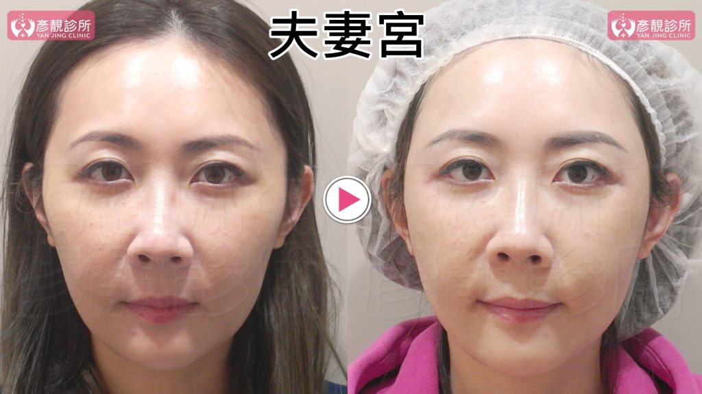 黃政達醫師透過大分子玻尿酸填補後改善個案夫妻宮凹陷太陽穴凹陷