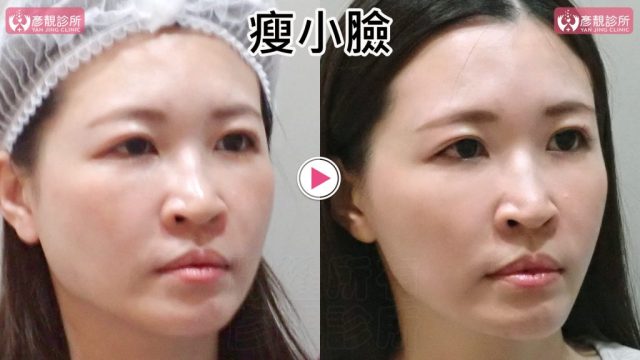 小臉02修 1024x576