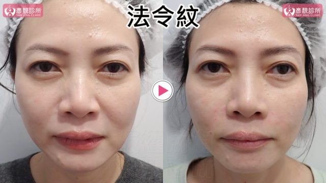 女性法令紋術前術後正面對照，右圖鼻翼基底至嘴角的折線與陰影較淡，法令紋上段及蘋果肌下緣銜接更平順；大分子玻尿酸依中臉支撐層次配置，保留鼻唇活動與臉型自然度