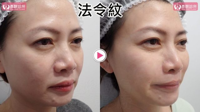 女性法令紋術前術後斜側近照，右圖鼻唇溝中段與口角上方暗線較淡，臉頰下緣接向嘴角的坡度更平順；大分子玻尿酸依組織區間支撐且無膠原增生造成的沾黏，保留表情活動與後續調整空間；材料無沾黏性可保留組織活動