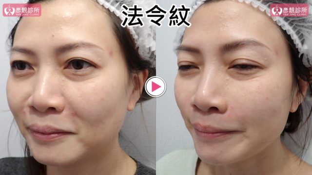 女性法令紋術前術後側面近照，右圖鼻翼外側至口角的凹折變淺，臉頰下緣陰影減少且口周輪廓更連續；大分子玻尿酸依血管與組織層次安排安全注射，不以單點大量填充追求全平