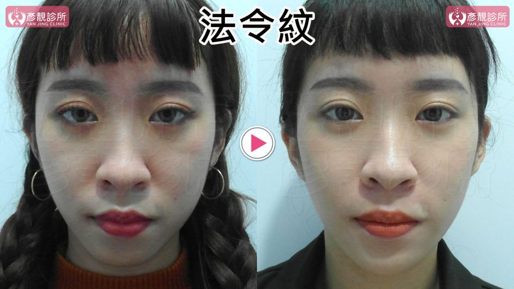 黃政達醫師利用大分子玻尿酸同時改善改善法令紋和嘴凸問題