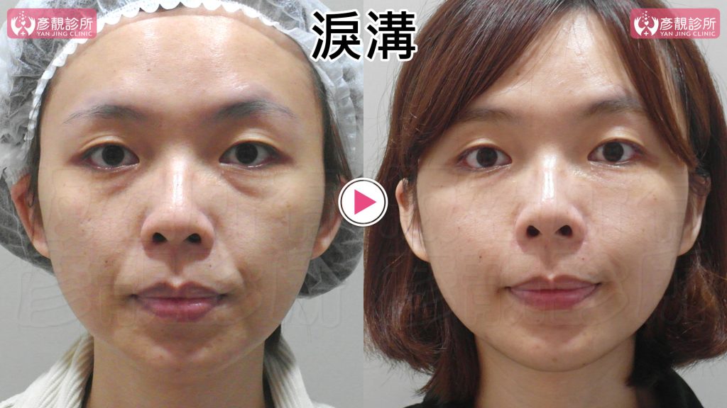 黃政達醫師利用大分子玻尿酸改善淚溝凹陷效果明顯