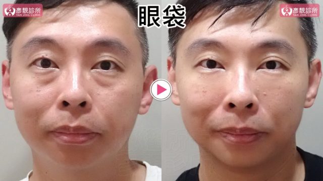 男性眼袋與淚溝術前術後正面近照，右圖雙側眼袋下緣暗帶與內眼角凹線較淡，下眼瞼至中臉的明暗分界更柔和；大分子玻尿酸依眼下血管和層次規劃安全支撐，並追蹤持久表現，同時維持自然眼下弧線
