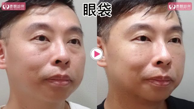 男性眼袋與淚溝術前術後另一斜側近照，右圖眼袋下方暗帶較短、內眼角凹線變淡，下眼瞼接向臉頰更平順；以不同表情核對自然度並控制眼下用量，避免把蘋果肌前側過度填充，並以同角度追蹤持久度