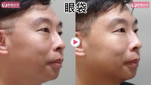 男性眼袋與淚溝術前術後斜側近照，右圖眼袋下緣隆起與凹陷落差較小，內眼角至顴頰的陰影變淡，眼下外觀更自然；治療以不同時間點追蹤持久度並保留眼瞼原有弧度