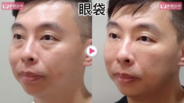 男性眼袋、淚溝術前術後斜側近照，右圖眼袋下緣凹線與內眼角暗帶較淡，眼下接向顴頰的坡度更連續；以同角度追蹤平順外觀的持久度，並保留眼瞼弧線與表情自然度，並核對雙側眼下落差