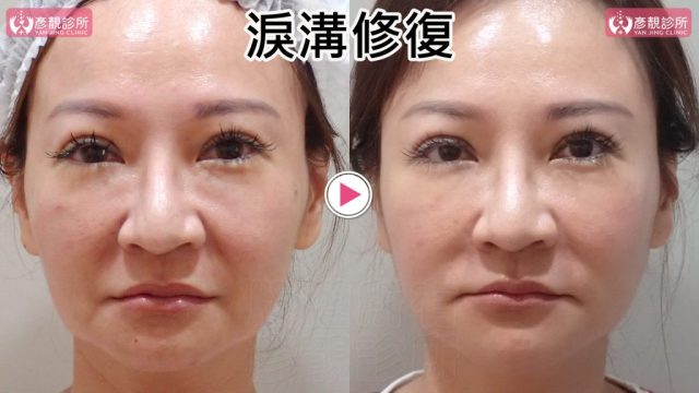淚溝失敗修復的正面術前術後照，右圖眼袋下緣凹影與內眼角暗帶減輕，下眼瞼到上臉頰銜接更平順；大分子玻尿酸融合法分散用量，可避免過度填充，眼下支撐可維持至少2年，並保留臥蠶。