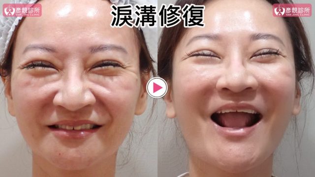淚溝失敗修復的大笑表情前後照，右圖眼袋下方條狀突起與淚溝暗線減輕，下眼瞼到蘋果肌的動態銜接更平順；大分子玻尿酸融合法重新整理眼下層次，利用無沾黏性保留臥蠶隆起、笑容與後續微調空間。