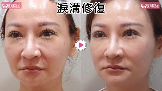 淚溝失敗修復的斜側術前術後照，右圖眼袋下方毛毛蟲般的條狀突起與淚溝陰影變淡，眼下到顴頰前側的落差縮小；大分子玻尿酸融合法分層整理既有材料並控制用量，可避免局部過度填充，保留臥蠶與自然側臉弧度。