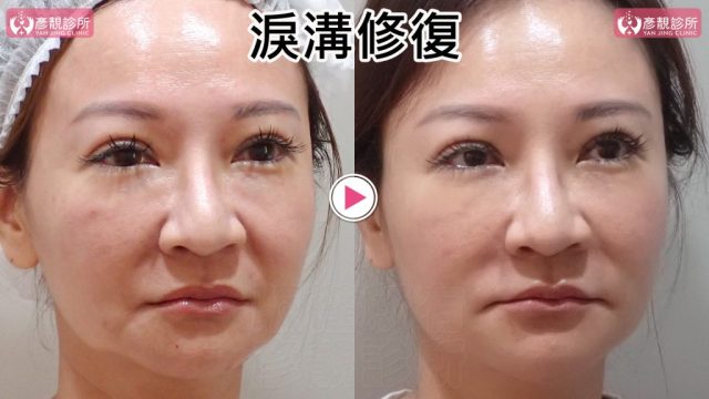 淚溝失敗修復的另一側斜臉前後照，右圖內眼角至眼袋下緣的條狀突起與凹影減輕，眼下到顴頰前側更平順；依血管位置與組織層次安全規劃大分子玻尿酸融合法，眼下支撐可維持至少2年，並保留原有眼瞼弧線。