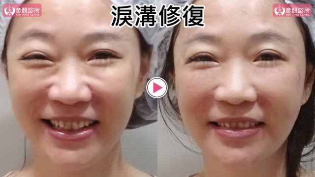 淚溝失敗修復的露齒微笑前後照，右圖雙側眼下毛毛蟲般的條狀突起與淚溝暗線變淡，下眼瞼到蘋果肌的動態銜接更平順；依血管位置與組織層次安全規劃大分子玻尿酸融合法，眼下支撐可維持至少2年並保留自然笑容。
