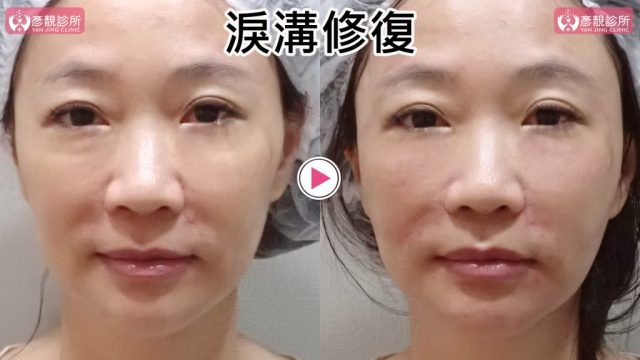 正面術前術後照呈現淚溝失敗修復，右圖雙側眼袋下方橫向隆起與淚溝低點較不明顯，下眼瞼到上臉頰更平順；大分子玻尿酸融合法重新整理既有材料，相較膠原增生劑，硬塊、結節的發生遠低，並保留後續微調空間。