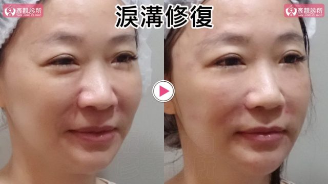 淚溝失敗修復的斜側微笑前後照，右圖眼袋下方橫向突起與淚溝暗線變淡，外側眼下通往上臉頰的起伏更平順；大分子玻尿酸融合法依表情重新整理位置與層次，可避免位移，並保留臥蠶隆起與原有臉頰弧度。