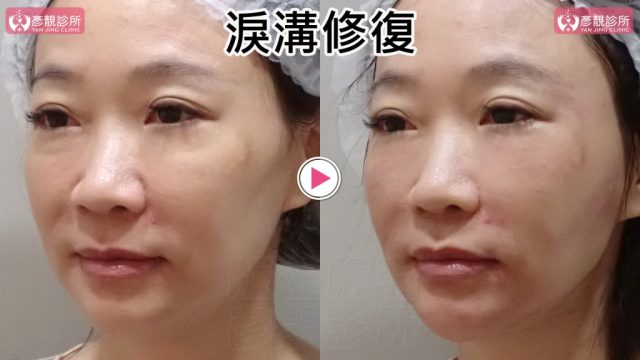 淚溝失敗修復的另一側斜臉前後照，右圖內眼角至眼袋下緣的毛毛蟲般條狀突起與凹影變淡，眼下到顴頰前側更平順；大分子玻尿酸融合法在適當層次重建支撐，保留眼瞼弧線、臥蠶與原有臉型，使側面眼下自然銜接。