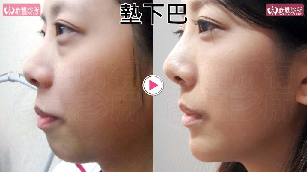 黃政達醫師利用大分子玻尿酸同時改善下巴後縮和嘴凸問題