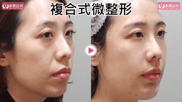 複合式微整形028